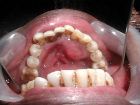 Figure 1: Clinical photograph showing 2.5 X 2 cm, non tender, firm swelling on the lingual aspect of mandible from the central incisor to second premolar on the left side.